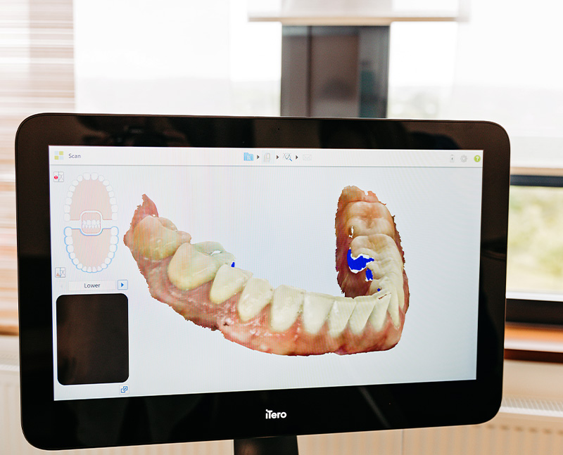 Orthodontische Miniimplantate